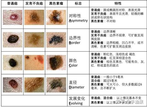 手臂很多痣|我的痣会变成黑色素瘤吗？大量图例看完就懂